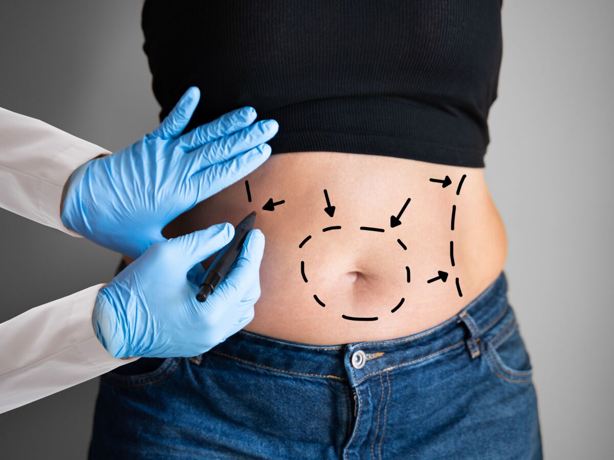 Abdominoplastie Quels M Decins Peuvent L Effectuer